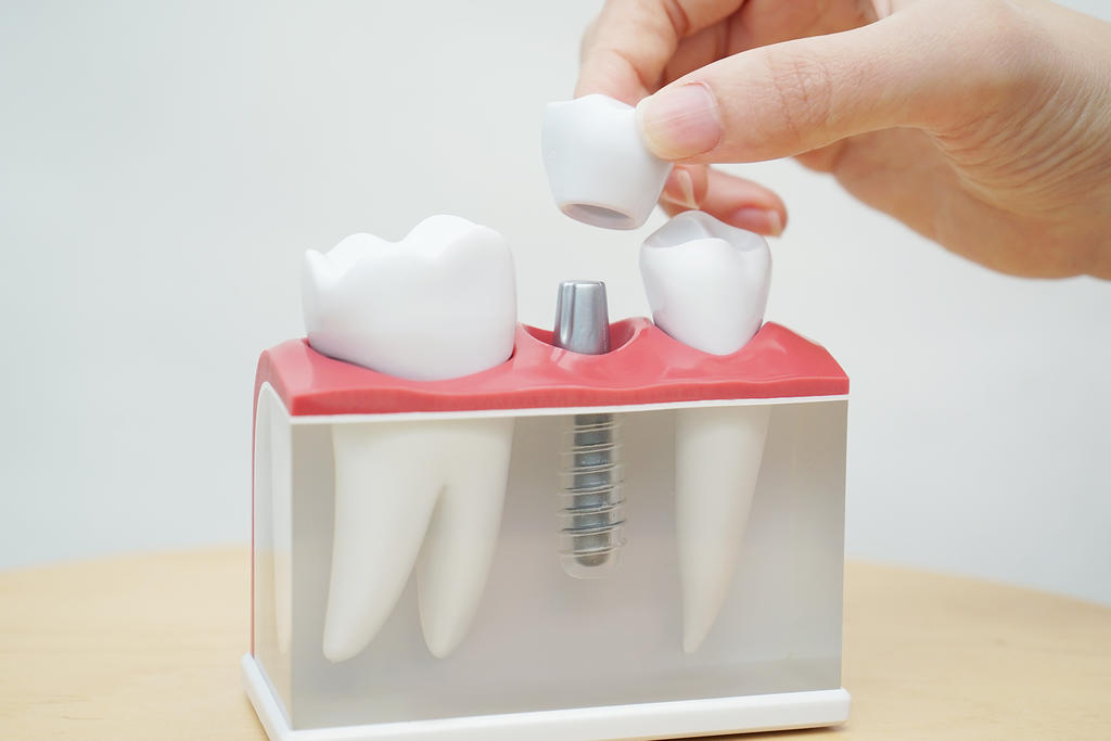 tooth implant singapore